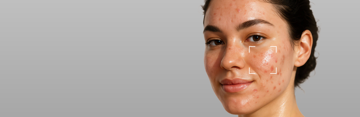 Acne Prone Skin